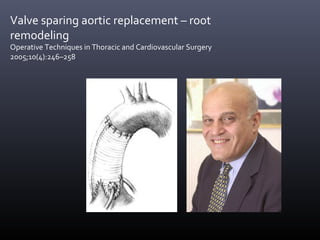 Valve sparing aortic replacement – root
remodeling
Operative Techniques in Thoracic and Cardiovascular Surgery
2005;10(4):246–258
 