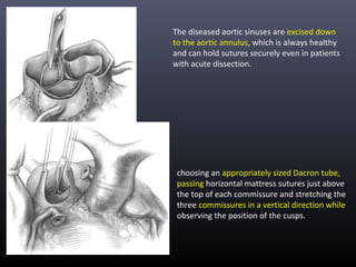 The diseased aortic sinuses are excised down
to the aortic annulus, which is always healthy
and can hold sutures securely even in patients
with acute dissection.
choosing an appropriately sized Dacron tube,
passing horizontal mattress sutures just above
the top of each commissure and stretching the
three commissures in a vertical direction while
observing the position of the cusps.
 