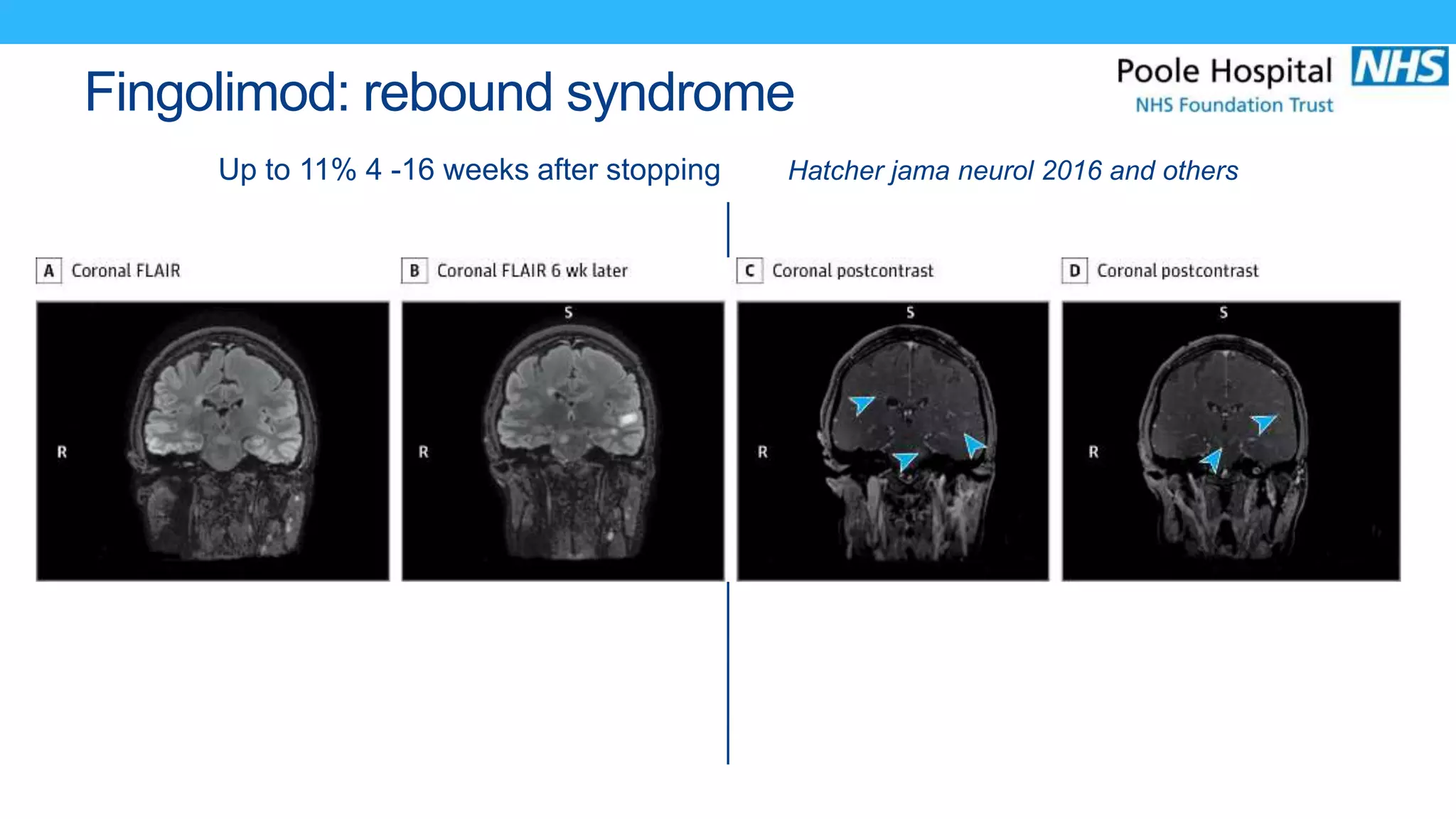 Fingolimod: rebound syndrome
Up to 11% 4 -16 weeks after stopping Hatcher jama neurol 2016 and others
 