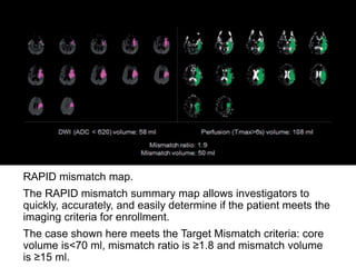 RAPID mismatch map.
The RAPID mismatch summary map allows investigators to
quickly, accurately, and easily determine if the patient meets the
imaging criteria for enrollment.
The case shown here meets the Target Mismatch criteria: core
volume is<70 ml, mismatch ratio is ≥1.8 and mismatch volume
is ≥15 ml.
 