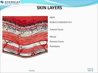 Training
Training
Manual
SKIN
SUBCUTANEOUS FAT
Anterior Fascia
Muscle
Posterior Fascia
Peritoneum
 