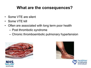 What are the consequences?

• Some VTE are silent
• Some VTE kill
• Often are associated with long term poor health
   – Post thrombotic syndrome
   – Chronic thromboembolic pulmonary hypertension
 