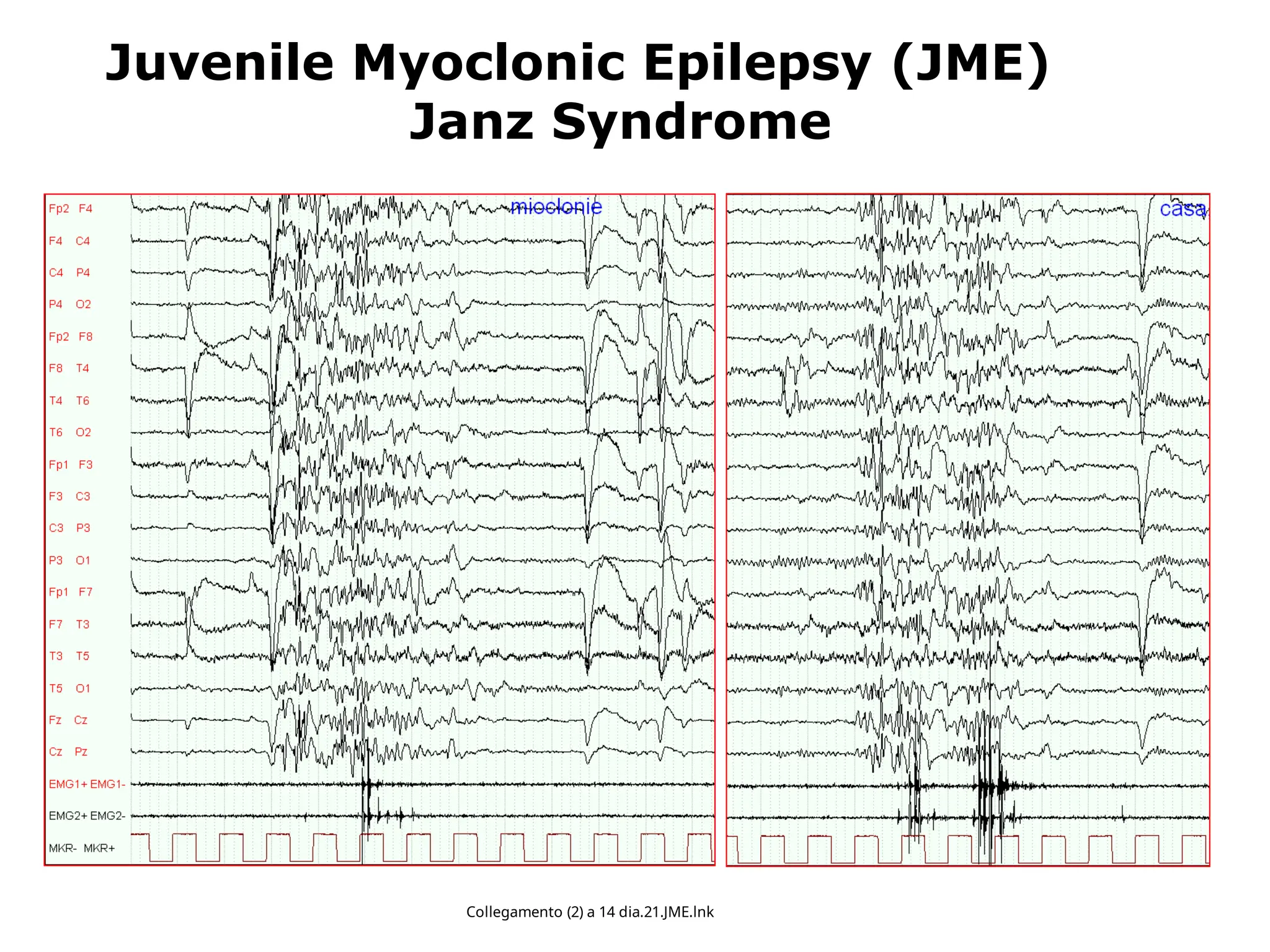 Juvenile Myoclonic Epilepsy (JME)
Janz Syndrome
Collegamento (2) a 14 dia.21.JME.lnk
 