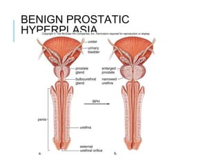 BENIGN PROSTATIC
HYPERPLASIA
 
