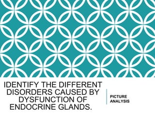 IDENTIFY THE DIFFERENT
DISORDERS CAUSED BY
DYSFUNCTION OF
ENDOCRINE GLANDS.
PICTURE
ANALYSIS
 