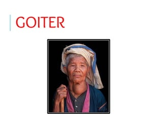 GOITER
 