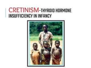 CRETINISM-THYROIDHORMONE
INSUFFICIENCYININFANCY
 