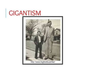GIGANTISM
 