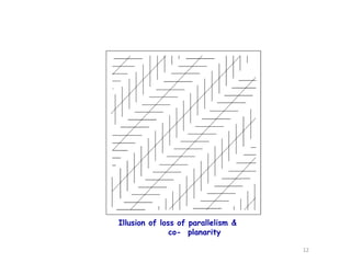 Illusion of loss of parallelism &
co- planarity
12
 