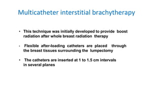 Interstitial Radiotherapy Techniques of Brachytherapy in breast cancer | PPTX