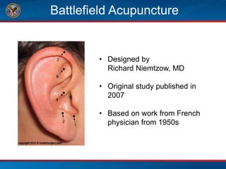 Battlefield Acupuncture
• Designed by
Richard Niemtzow, MD
• Original study published in
2007
• Based on work from French
physician from 1950s
 