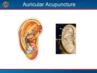 Auricular Acupuncture
 