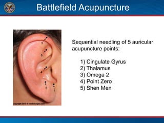 Battlefield Acupuncture
Sequential needling of 5 auricular
acupuncture points:
1) Cingulate Gyrus
2) Thalamus
3) Omega 2
4) Point Zero
5) Shen Men
 
