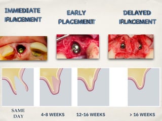 Guided bone regeneration in implantology and periodontology | PDF