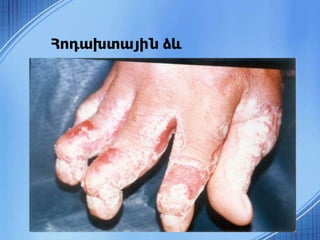 Հոդախտային ձև
 