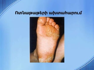 Ոտնաթաթերի ախտահարում
 
