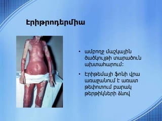 • ամբողջ մաշկային
ծածկույթի տարածուն
ախտահարում:
• Էրիթեմայի ֆոնի վրա
առաջանում է առատ
թեփոտում բարակ
թերթիկների ձևով
Էրիթրոդերմիա
 