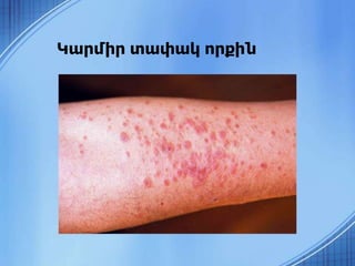 Կարմիր տափակ որքին
 