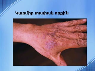 Կարմիր տափակ որքին
 