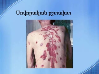 Սովորական բշտախտ
 