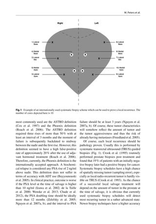 most commonly used are the ASTRO definition
(Cox et al. 1997) and the Phoenix definition
(Roach et al. 2006). The ASTRO definition
required three rises of more than 50 % with at
least an interval of 3 months and the moment of
failure is subsequently backdated to midway
between the nadir and the first rise. However, this
definition seemed to have a high false-positive
rate of approximately 20 % after the use of adju-
vant hormonal treatment (Roach et al. 2006).
Therefore, currently, the Phoenix definition is the
internationally accepted approach. A biochemi-
cal relapse is considered any PSA rise of 2 ng/ml
above nadir. This definition does not suffer in
terms of accuracy with ADT use (Buyyounouski
et al. 2005). In clinical practice, outcome is worse
if the PSA level at the time of salvage is higher
than 10 ng/ml (Izawa et al. 2002; de la Taille
et  al. 2000; Wenske et  al. 2013; Chade et  al.
2012), the PSA doubling time should be ideally
more than 12 months (Zelefsky et  al. 2005;
Nguyen et al. 2007a, b), and the interval to PSA
failure should be at least 3 years (Nguyen et al.
2007a, b). Of course, these tumor characteristics
will somehow reflect the amount of tumor and
the tumor aggressiveness and thus the risk of
already having metastases (Freedland et al. 2005).
Of course, each local recurrence should be
pathology proven. Usually this is performed by
systematic transrectal ultrasound (TRUS)-guided
biopsies (Fig.  1). Crook et  al. (1995) routinely
performed prostate biopsies post treatment and
found that 19 % of patients with an initially nega-
tive biopsy later had a positive biopsy for cancer.
Systematic biopsy schedules have a high chance
of spatially missing tumor (sampling error), espe-
cially as local radio-recurrent tumor is hardly vis-
ible on TRUS (Crook et al. 1993). As the chance
of a successful local salvage treatment will
depend on the amount of tumor in the prostate at
the time of salvage, it is obvious that currently
used systematic biopsy schedules will detect
most recurring tumor in a rather advanced state.
Newer biopsy techniques have a higher accuracy
Fig.1  Example of an internationally used systematic biopsy scheme which can be used to prove a local recurrence. The
number of cores depicted here is 10
M. Peters et al.
 