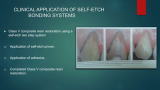 CLINICAL APPLICATION OF SELF-ETCH
BONDING SYSTEMS
 Class V composite resin restoration using a
self-etch two step system
a) Application of self-etch primer.
b) Application of adhesive.
c) Completed Class V composite resin
restoration.
 