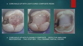  CORE BUILD-UP WITH LIGHT-CURED COMPOSITE RESIN:
 CORE BUILD UP WITH FLOWABLE COMPOSITE….DEFECTIVE AMALGAM
RESTORATION…..TWO STEP SEA….FULL CERAMIC PARTIAL CROWN
 