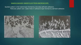 NANOLEAKAGE UNDER ELECTRON MICROSCOPE.
Spotted pattern in the hybrid layer formed by one-step self-etch adhesive
Reticular pattern and water trees in adhesive layer formed by self etch adhesive
 