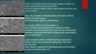 Figure 1 Scanning electron microscopic images of dentin: (A)
rotary-prepared and acid-etched (3500!),
(B) laser-prepared (9000!), and (C) laser-prepared and then acid-
etched (3500!).
(Fig. 1A) revealed a smoothsurface with tubule orifices
devoid of smear plugs.
The intertubular dentin is undisturbed.
In contrast, SEM of a cross-section of
laser-ablated, laser-etched dentin showed a highly
irregular surface and fissuring. Areas of poor hybridization
between composite and dentin suggest poor hybridization,
or no hybridization.
Laser-prepared dentin revealed surface scaling and
flaking, along with peritubular cuffing (Fig. 1B). Acid-
etching after
laser ablation appeared to decrease some of the surface
scaling and flaking (Fig. 1C).
 