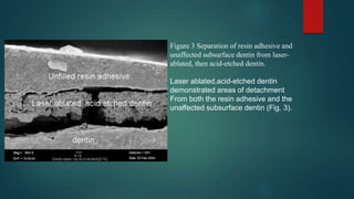Figure 3 Separation of resin adhesive and
unaffected subsurface dentin from laser-
ablated, then acid-etched dentin.
Laser ablated,acid-etched dentin
demonstrated areas of detachment
From both the resin adhesive and the
unaffected subsurface dentin (Fig. 3).
 
