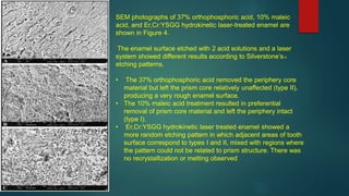 SEM photographs of 37% orthophosphoric acid, 10% maleic
acid, and Er,Cr:YSGG hydrokinetic laser-treated enamel are
shown in Figure 4.
The enamel surface etched with 2 acid solutions and a laser
system showed different results according to Silverstone’s10
etching patterns.
• The 37% orthophosphoric acid removed the periphery core
material but left the prism core relatively unaffected (type II),
producing a very rough enamel surface.
• The 10% maleic acid treatment resulted in preferential
removal of prism core material and left the periphery intact
(type I).
• Er,Cr:YSGG hydrokinetic laser treated enamel showed a
more random etching pattern in which adjacent areas of tooth
surface correspond to types I and II, mixed with regions where
the pattern could not be related to prism structure. There was
no recrystallization or melting observed
 
