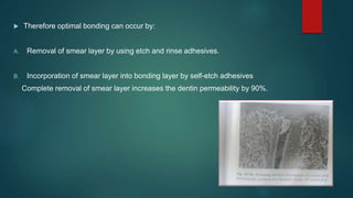  Therefore optimal bonding can occur by:
A. Removal of smear layer by using etch and rinse adhesives.
B. Incorporation of smear layer into bonding layer by self-etch adhesives
Complete removal of smear layer increases the dentin permeability by 90%.
 