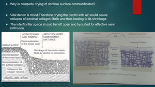  Why is complete drying of dentinal surface contraindicated?
 Vital dentin is moist.Therefore drying the dentin with air would cause
collapse of dentinal collagen fibrils and thus leading to its shrinkage.
 The interfibrillar space should be left open and hydrated for effective resin
infiltration.
 