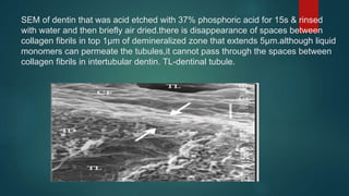 SEM of dentin that was acid etched with 37% phosphoric acid for 15s & rinsed
with water and then briefly air dried.there is disappearance of spaces between
collagen fibrils in top 1µm of demineralized zone that extends 5µm.although liquid
monomers can permeate the tubules,it cannot pass through the spaces between
collagen fibrils in intertubular dentin. TL-dentinal tubule.
 