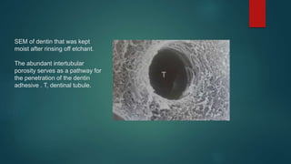 SEM of dentin that was kept
moist after rinsing off etchant.
The abundant intertubular
porosity serves as a pathway for
the penetration of the dentin
adhesive . T, dentinal tubule.
 