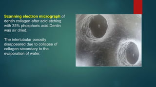 Scanning electron micrograph of
dentin collagen after acid etching
with 35% phosphoric acid.Dentin
was air dried.
The intertubular porosity
disappeared due to collapse of
collagen secondary to the
evaporation of water.
 