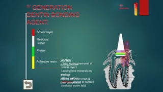 1st step:
-Total etching(removal of
smear layer)
Leaving free minerals on
surface
-Rinse surface
-Without drying of surface
(residual water left)
2nd step :
adding primer
3rd step:
Adding adhesive resin &
then composite
Composite
Smear layer
Residual
water
Primer
Adhesive resin
 