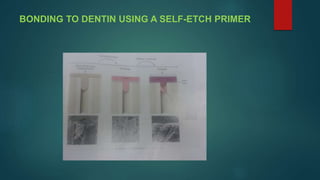 BONDING TO DENTIN USING A SELF-ETCH PRIMER
 