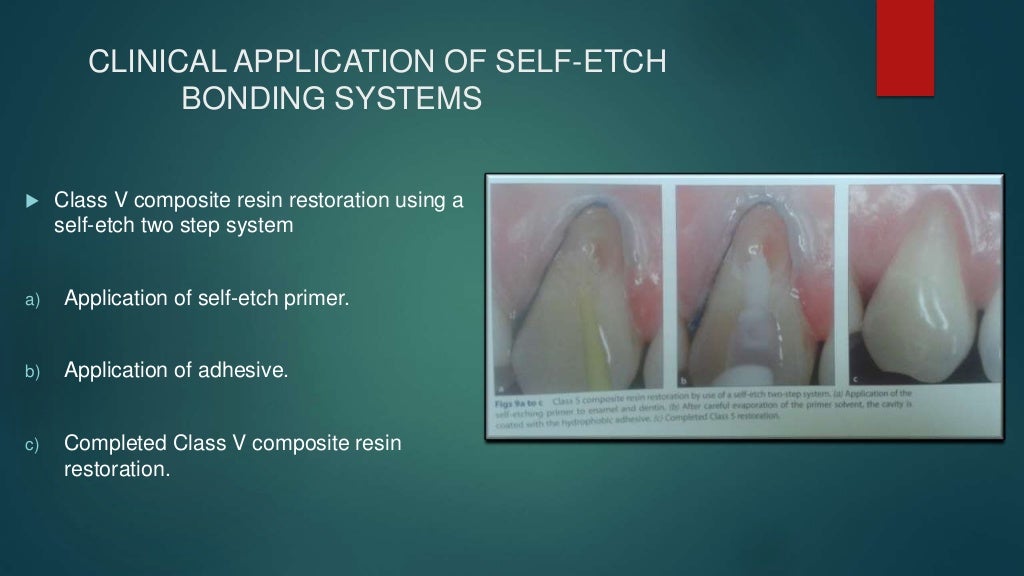 dentin bonding agents