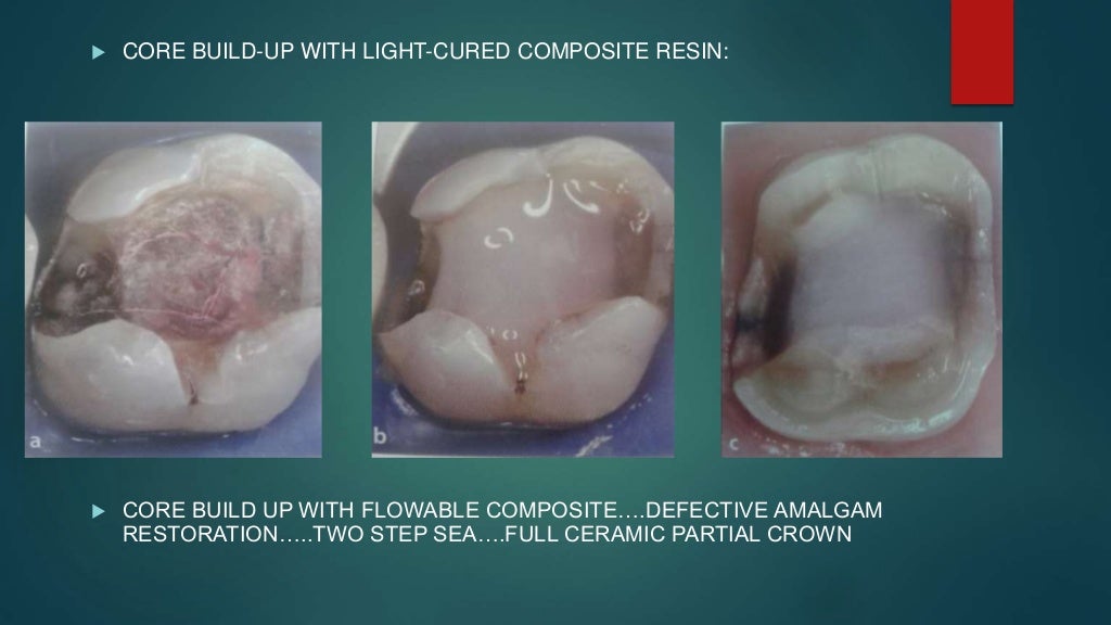 dentin bonding agents
