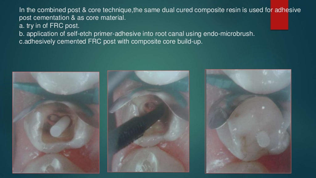 dentin bonding agents