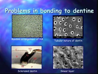 DENTIN BONDING AGENTS | PPT