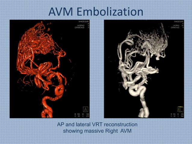 Introduction to Neuroendovascular Surgery | PPTX