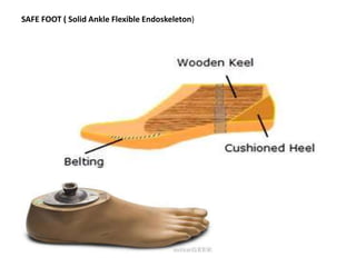 SAFE FOOT ( Solid Ankle Flexible Endoskeleton)
 