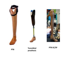 PTB
Transtibial
prosthesis
PTB SC/SP
 