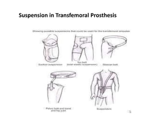 Suspension in Transfemoral Prosthesis
 