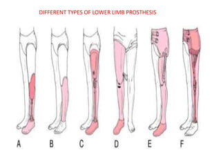 DIFFERENT TYPES OF LOWER LIMB PROSTHESIS
 