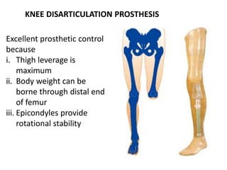 KNEE DISARTICULATION PROSTHESIS
Excellent prosthetic control
because
i. Thigh leverage is
maximum
ii. Body weight can be
borne through distal end
of femur
iii. Epicondyles provide
rotational stability
 