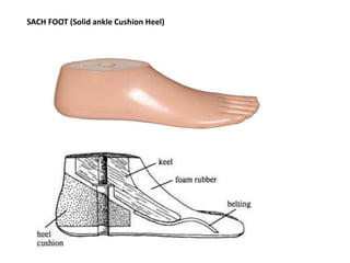 SACH FOOT (Solid ankle Cushion Heel)
 