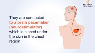Deep Brain Stimulation for Parkinson's disease | Treatment at Yashoda ...